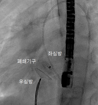 심방중격결손 폐쇄술의 시술