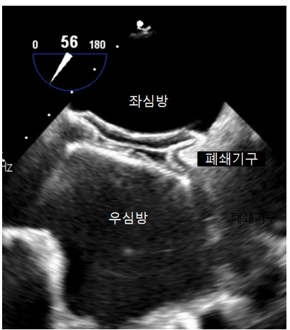 심방중격결손 폐쇄술의 초음파 영상