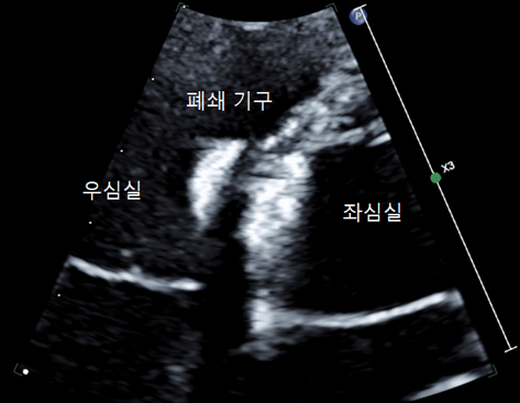 심실중격결손 폐쇄술 후 초음파 영상