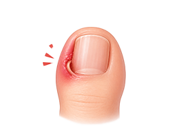 내성발톱